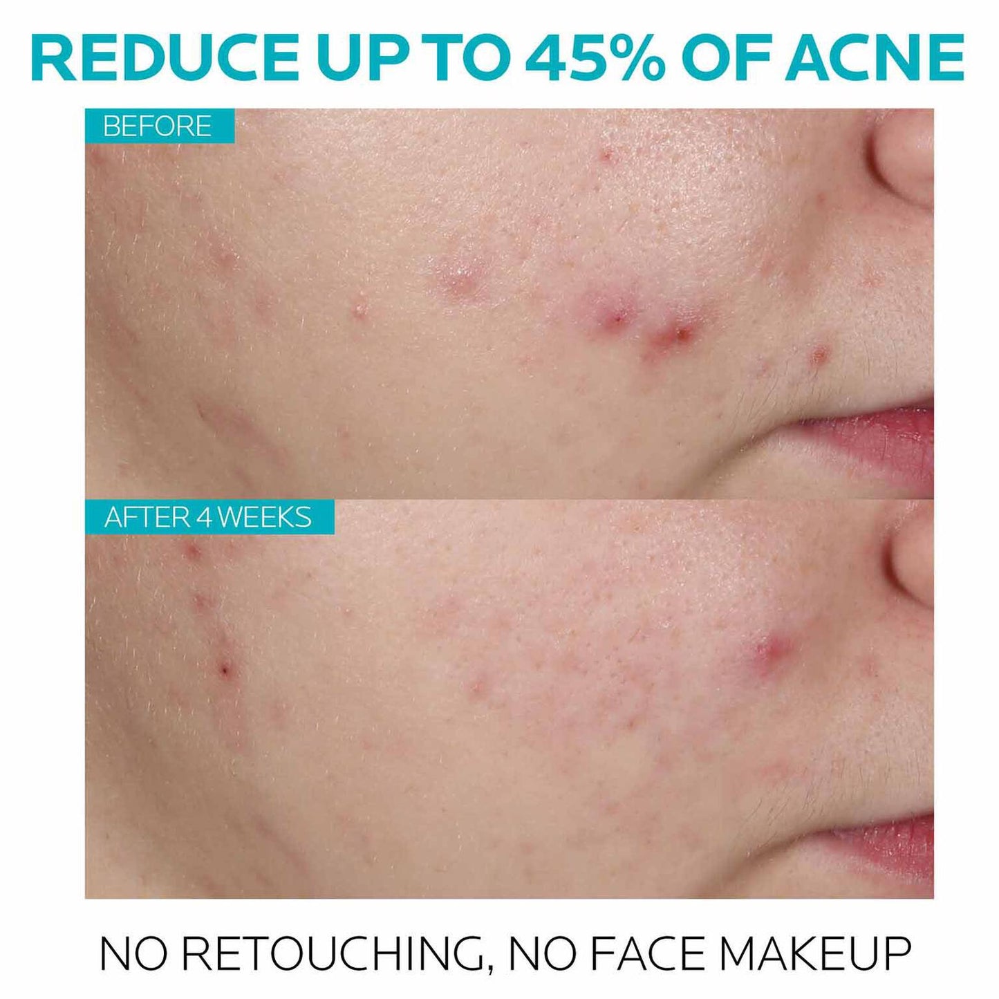 effaclar-salicylic-acid-acne-treatment-serum-c6 7_EffaclarSerum_After-45-days.jpg