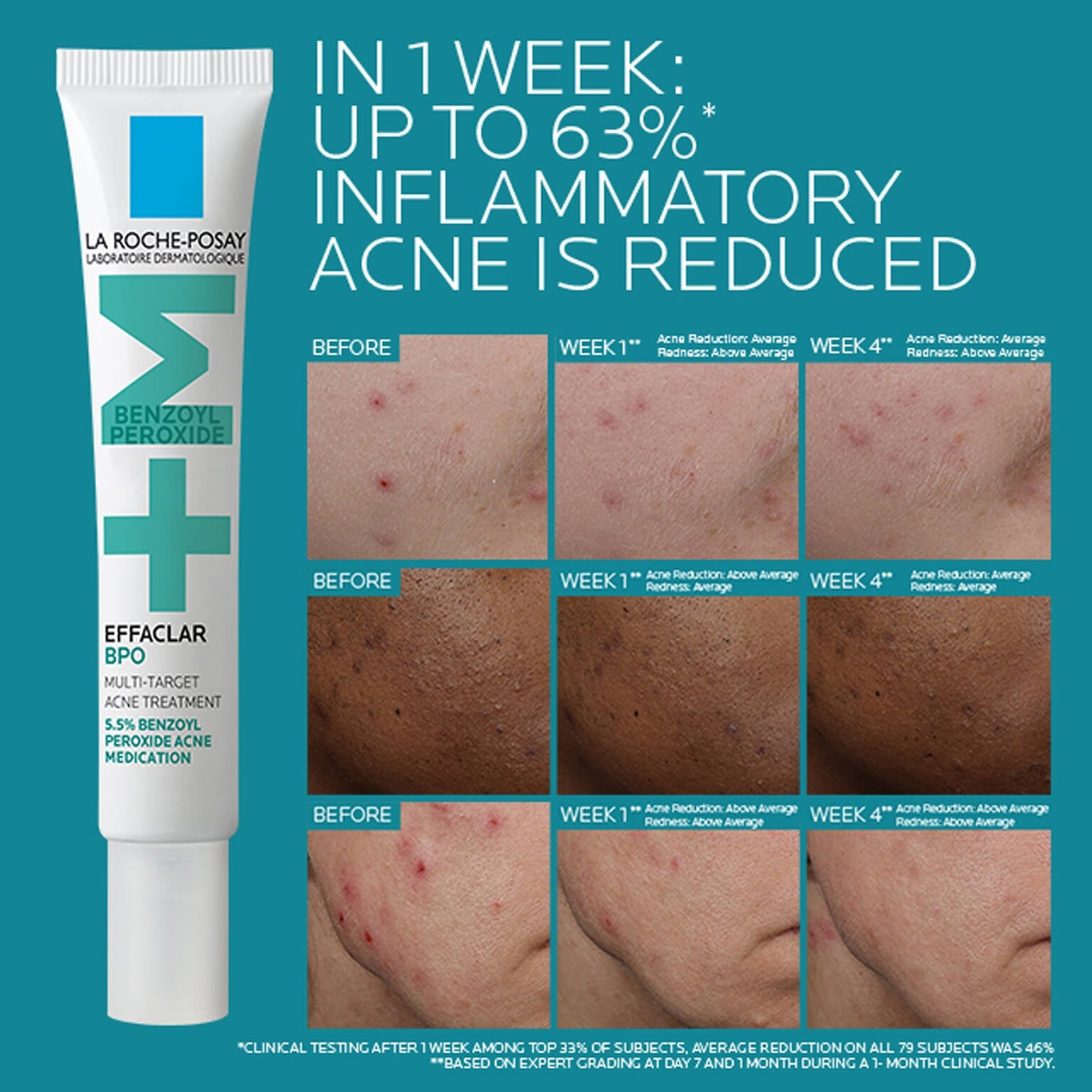 effaclar-bpo-multi-target-acne-treatment-with-5-5-benzoyl-peroxide-y3 EffaclarBPO-ClinicalBA-ATF-1500x1500-2.jpg