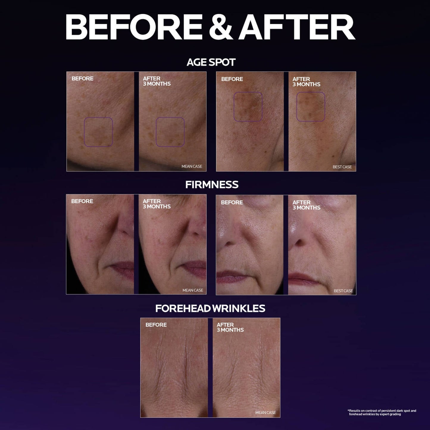 mela-b3-double-dose-discoloration-treatment-with-melasyltm-o8 MelaB3_DD_BTF_BeforeAfter_1500x1500_5.jpg