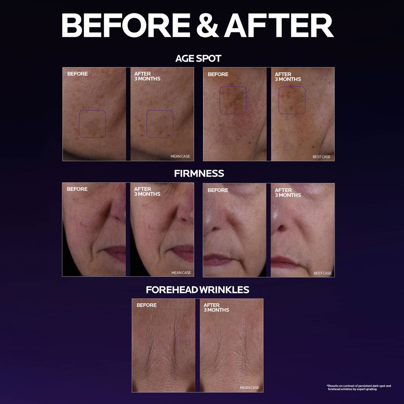 mela-b3-double-dose-discoloration-treatment-with-melasyltm-o8 MelaB3_DD_BTF_BeforeAfter_1500x1500_5.jpg